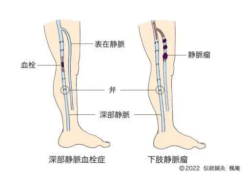 下肢静脈瘤｜伝統鍼灸 楓庵