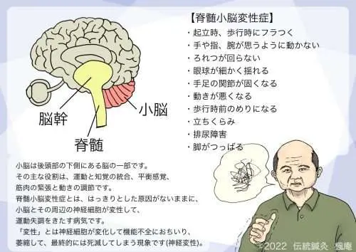 疾患】脊髄小脳変性症｜伝統鍼灸 楓庵