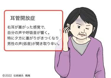 【症例集】耳管開放症