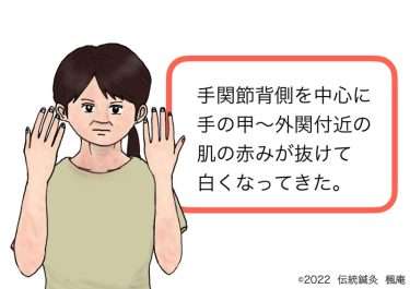 【治療日誌】アトピー性皮膚炎  No.3