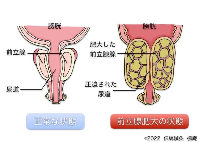 【メーカー包装済】 前立腺肥大｜伝統鍼灸 楓庵 医学一般
