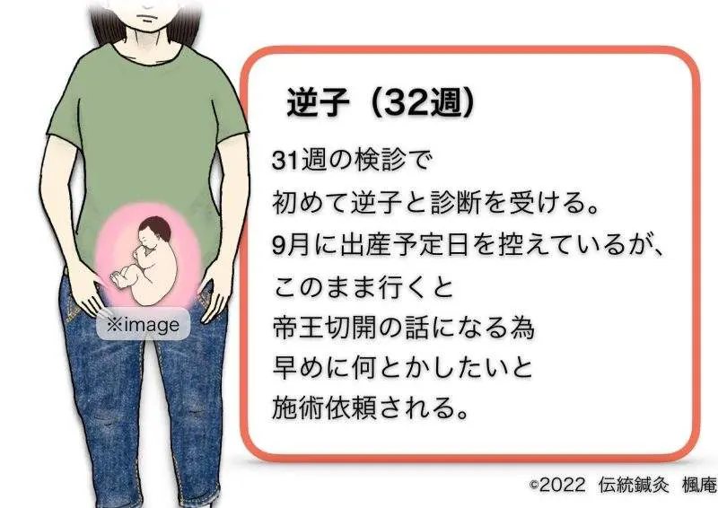 治療日誌】逆子 No.1|伝統鍼灸 楓庵 治療日誌】逆子 No.1|伝統鍼灸 楓庵