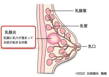 【疾患解説】乳腺炎