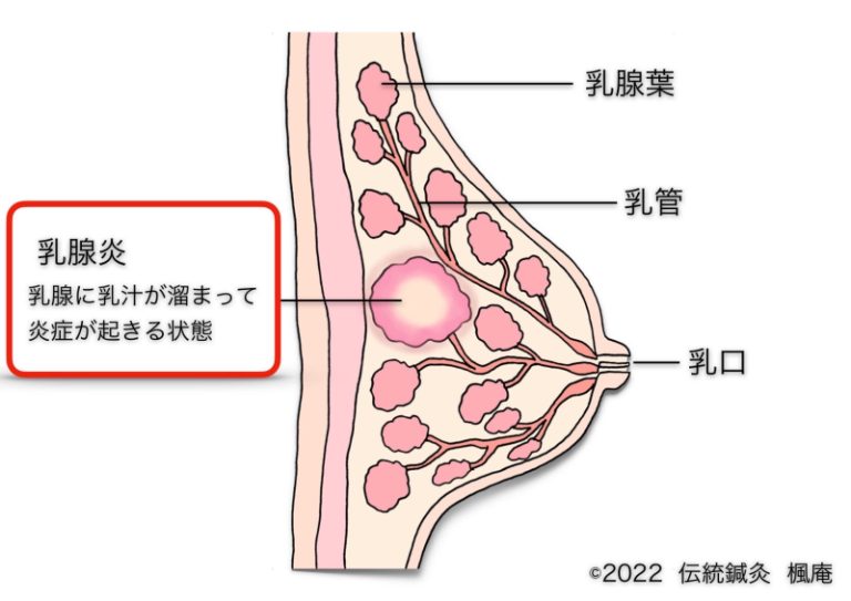 乳腺炎 伝統鍼灸 楓庵
