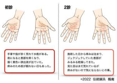 【治療日誌】手湿疹  No.2