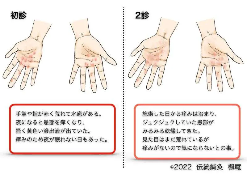 症例】皮膚疾患｜伝統鍼灸 楓庵