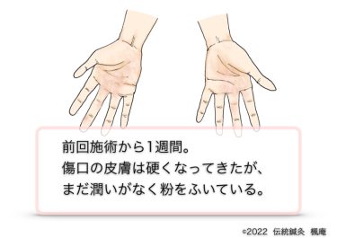 【治療日誌】手湿疹 No.4