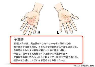 【治療日誌】手湿疹  No.1
