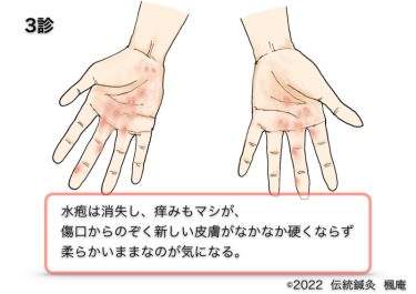 【治療日誌】手湿疹  No.3