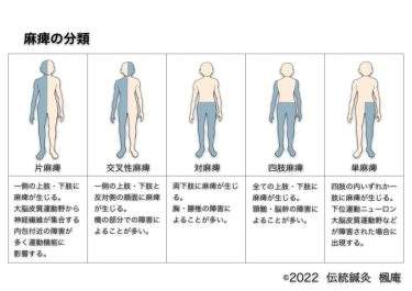 麻痺について