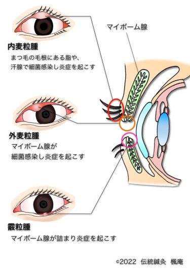 麦粒腫・霰粒腫