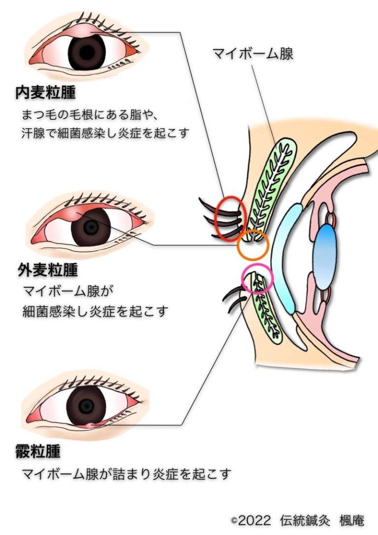 麦粒腫・霰粒腫 | 伝統鍼灸楓庵｜大阪府吹田市の伝統鍼灸院