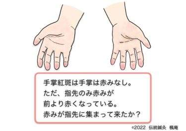【治療日誌】皮膚掻痒・くも状血管腫・手掌紅斑 No.3