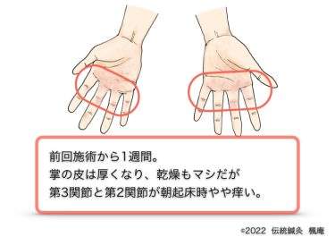 【治療日誌】手湿疹 No.5