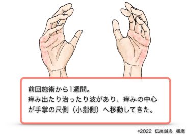 【治療日誌】手湿疹 No.6