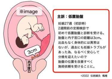 【治療日誌】低置胎盤 No.1