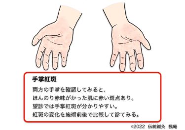 【治療日誌】皮膚掻痒・くも状血管腫・手掌紅斑 No.1