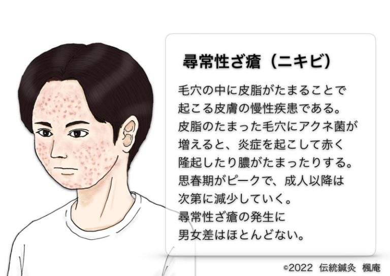 尋常性ざ瘡(ニキビ) | 伝統鍼灸楓庵|大阪府吹田市の伝統鍼灸院