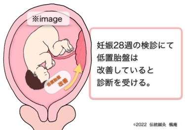【治療日誌】低置胎盤 No.2
