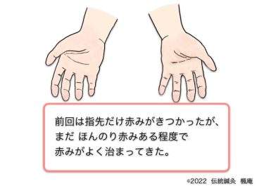 【治療日誌】皮膚掻痒・くも状血管腫・手掌紅斑 No.4