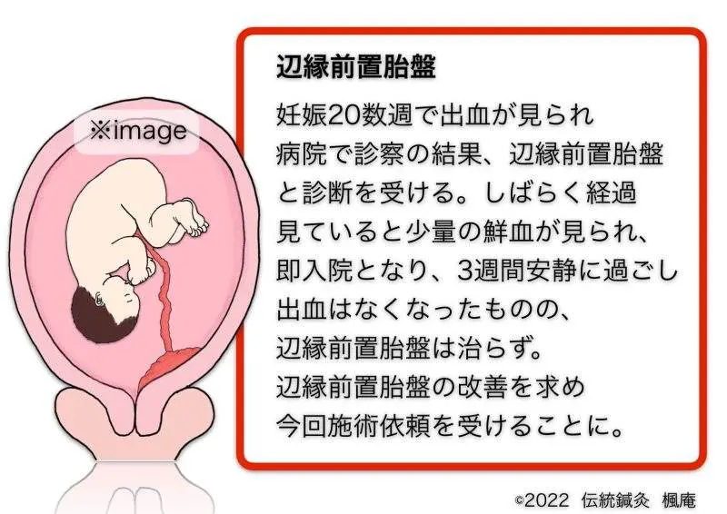 楽天ブックス: 前置胎盤・前置癒着胎盤の手術 - 入念な準備で