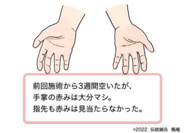 【治療日誌】皮膚掻痒・くも状血管腫・手掌紅斑 No.5