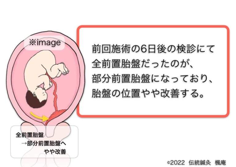 治療日誌】全前置胎盤(3) No.2｜伝統鍼灸 楓庵