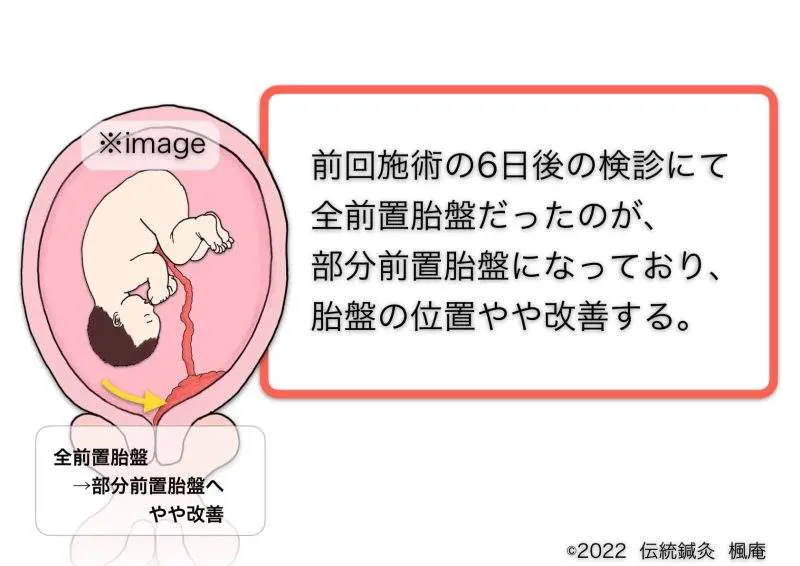 治療日誌】全前置胎盤(3) No.2｜伝統鍼灸 楓庵