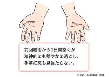 【治療日誌】皮膚掻痒・くも状血管腫・手掌紅斑 No.6
