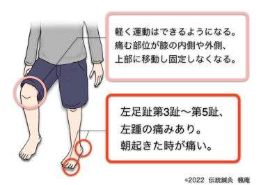 【治療日誌】変形性膝関節症 No.10