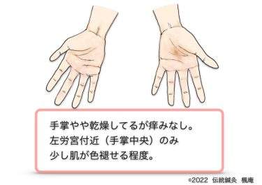 【治療日誌】手湿疹 No.8