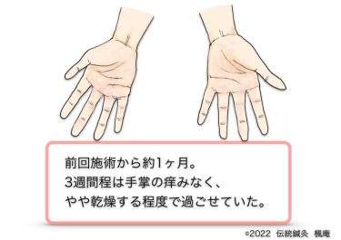 【治療日誌】手湿疹 No.7