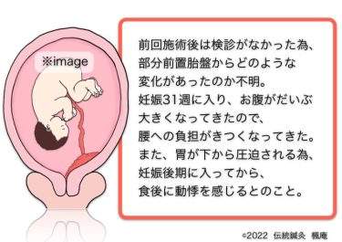 【治療日誌】全前置胎盤(3) No.3
