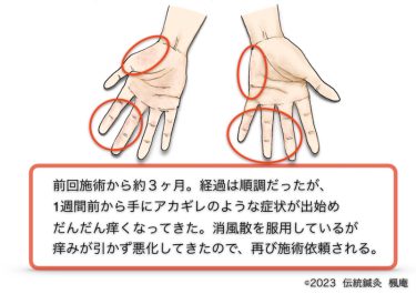 【治療日誌】手湿疹 No.9