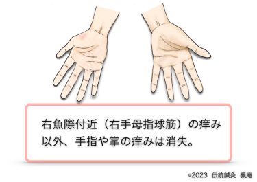 【治療日誌】手湿疹 No.10