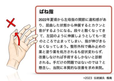 【症例集】ばね指(3)