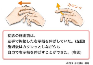 【治療日誌】ばね指(4)・メニエール病(3) No.2