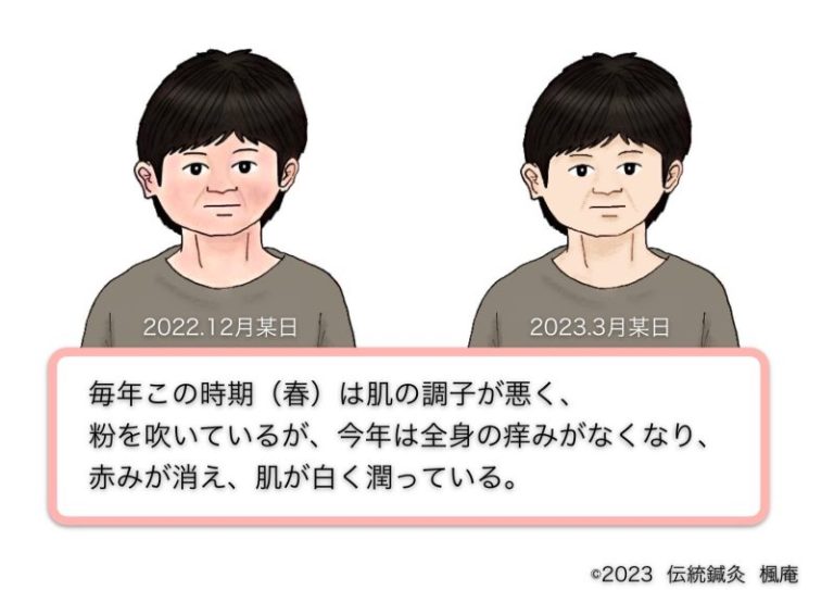 治療日誌】アトピー性皮膚炎(12) No.3｜伝統鍼灸 楓庵