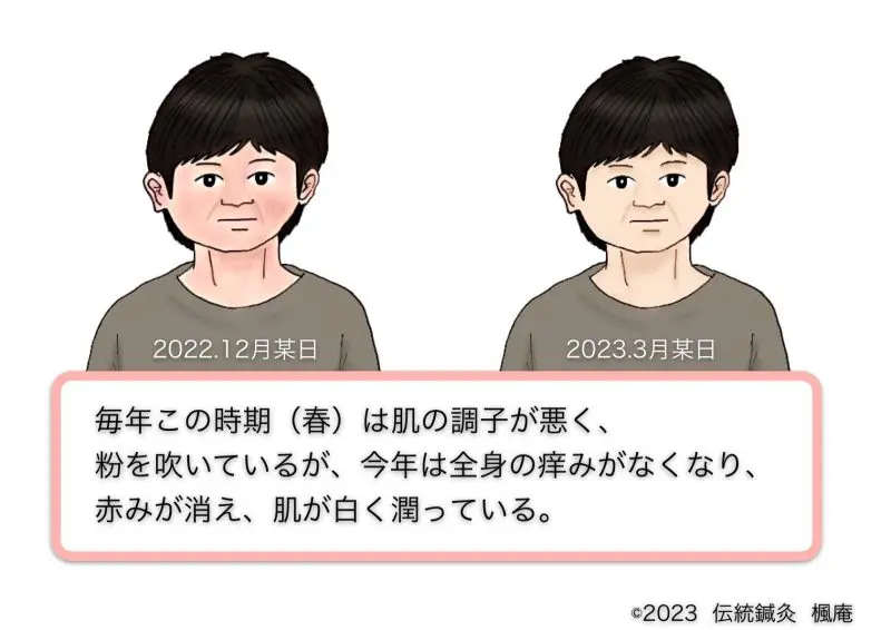 治療日誌】アトピー性皮膚炎(4) No.9｜伝統鍼灸 楓庵