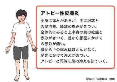 【治療日誌】アトピー性皮膚炎(9) No.1