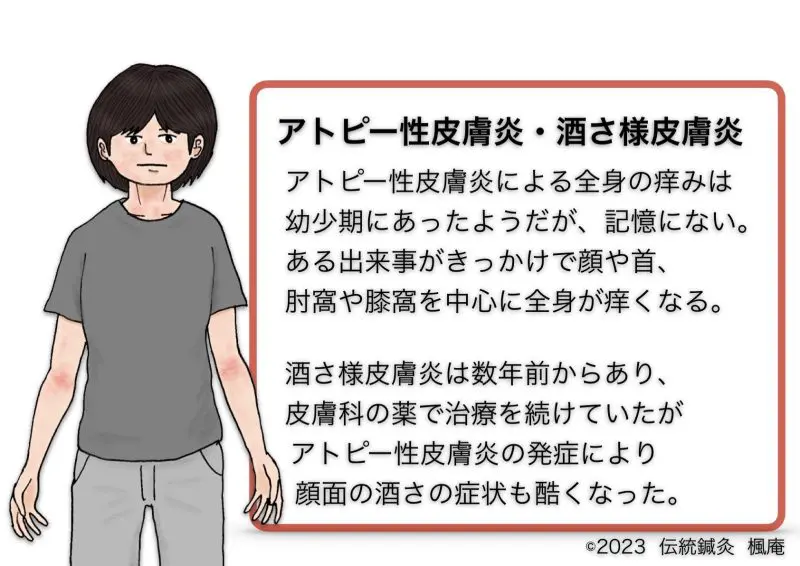 治療日誌】アトピー性皮膚炎(10)・酒さ様皮膚炎 No.1｜伝統鍼灸 楓庵