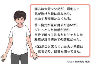 【治療日誌】アトピー性皮膚炎(9) No.4