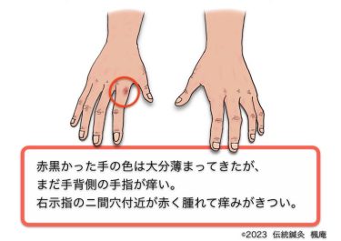 【治療日誌】アトピー性皮膚炎(11)・手湿疹(2) No.2