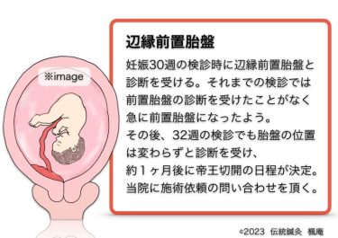 【治療日誌】辺縁前置胎盤(6) No.1