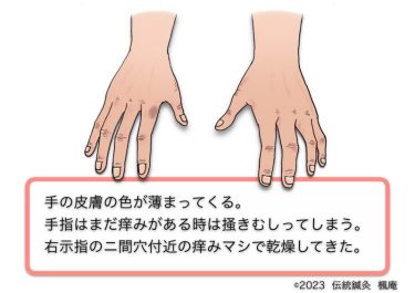 【治療日誌】アトピー性皮膚炎(11)・手湿疹(2) No.3
