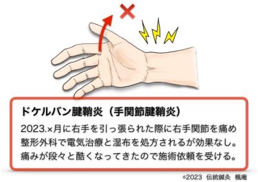 【治療日誌】ドケルバン腱鞘炎(手関節腱鞘炎) No.1