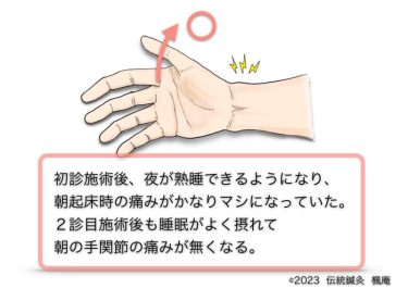 【治療日誌】ドケルバン腱鞘炎(手関節腱鞘炎) No.2