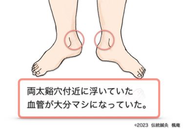 【治療日誌】下肢静脈瘤 No.2