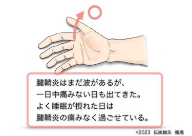 【治療日誌】ドケルバン腱鞘炎(手関節腱鞘炎) No.3