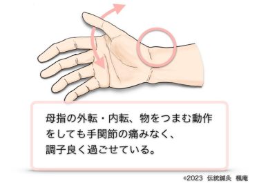 【治療日誌】ドケルバン腱鞘炎(手関節腱鞘炎) No.4